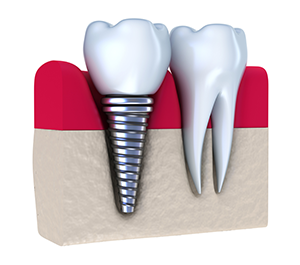 Dental Implants | Dentist in Bourbonnais, IL | Bourbonnais Family Dental
