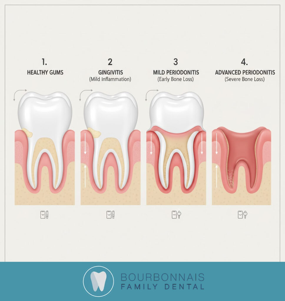 Infographic showing the progression of gum disease from healthy gums to gingivitis, mild periodontitis, and advanced periodontitis with bone loss.